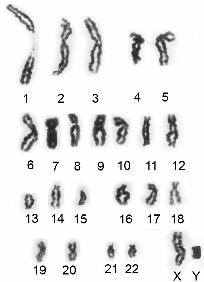 Suma aberracji struktury i/lub liczby chromosomów plemnikowych u każdego z badanych pacjentów była wysoka i wynosiła: 13% w przypadku Nr 24, 12% w przypadku Nr 29 i 21% w przypadku Nr 39 (tabela 15).