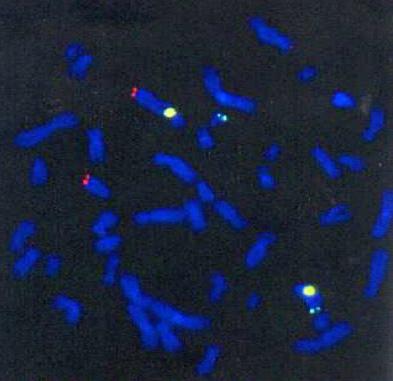 Sygnały trójkolorowego FISH zastosowanego do znakowania chromosomów 7 i 13 u nosiciela t(7;13)(q34;q13) w limfocytach (A, B oraz C) i w plemnikach pochodzących z różnych typów segregacji mejotycznej
