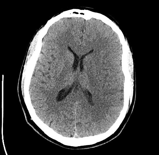Złośliwy obrzęk mózgu leczony kompleksowo i skutecznie opis dwóch przypadków RYCINA 1. Obraz tomografii komputerowej przed zabiegiem operacyjnym RYCINA 2. Obraz tomografii komputerowej w 5.