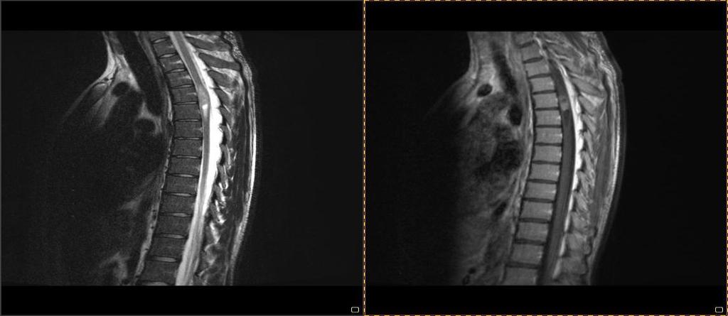 Neurofizjologiczny monitoring w operacjach guzów