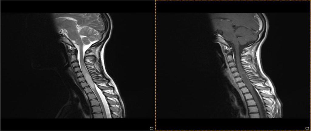 Neurofizjologiczny monitoring w operacjach guzów