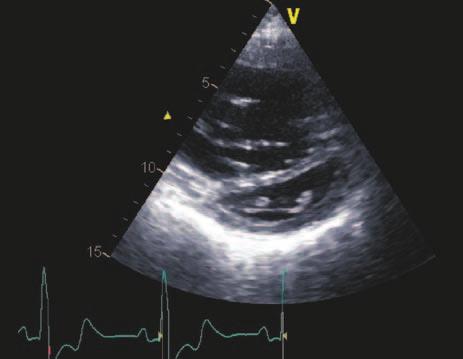 Folia Cardiologica Excerpta 2010, tom 5, nr 5 Opis przypadku Rycina 1. Prawa komora w projekcji czterojamowej koniuszkowej 4C Rycina 2.