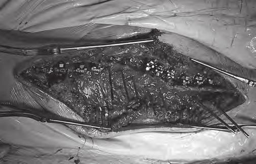 OPIS METODY Chir. Narzadow Ruchu Ortop. Pol., 2016; 81(2) 31-37 Rafał Pankowski et al., Gdańska technika implantacji śrub przeznasadowych w operacyjnym leczeniu skoliozy idiopatycznej opis metody Ryc.
