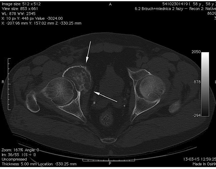 .. In 4 patients we have performed microscopically radical resection (R0), whereas in a patient suffering from chondrosarcoma relapse we have performed macroscopically radical resection, but