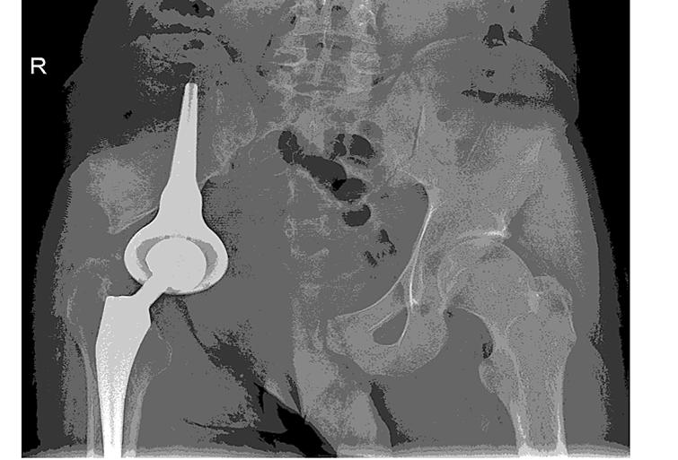 In one case it happened due to loosening of the femoral stem prosthesis on the 11th day after the primary surgery.