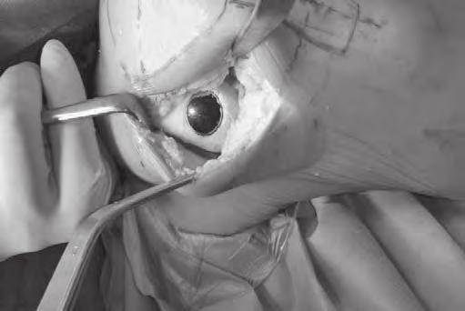 System charakteryzuje się precyzyjnym dopasowaniem implantu do ubytku chrząstki stawowej, pozwala na odtworzenie gładkiej i