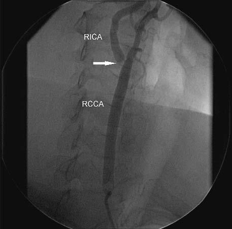 Ryc. 1. Subtotalne, ostialne (strza³ka) zwê enie RICA Fig. 1. Subtotal, ostial (arrow) RICA stenosis Ryc. 2.