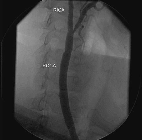 Ryc. 3. Ostateczny rezultat stentowania RICA oraz RCCA Fig. 3. Final result of RCCA and RICA stenting Ryc. 4. Istotne, 70% zwê enie RICA w odcinku proksymalnym (strza³ka) Fig. 4. Significant, 70% RICA narrowing (arrow) zewnêtrznej prawej).