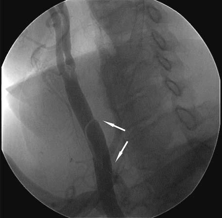 Ryc. 5. Rozleg³a dyssekcja têtnicy szyjnej wspólnej prawej (strza³ki) Fig. 5. Extensive dissection of right common cartoid artery (arrows) Ryc. 6. Ostateczny rezultat stentowania RCCA oraz RICA Fig.
