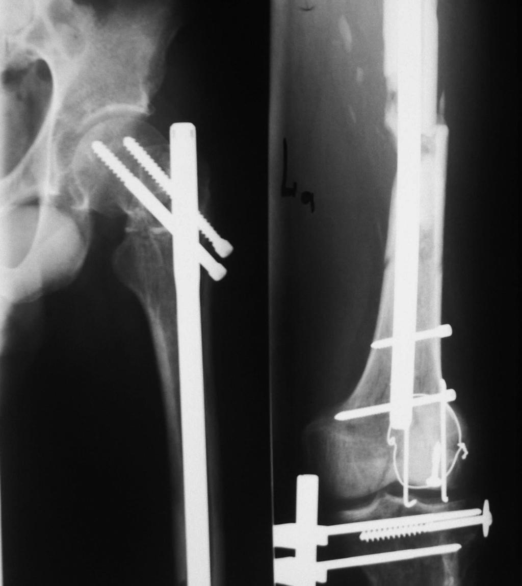 Wójcik K., Concomitant Ipsilateral Femoral Neck an