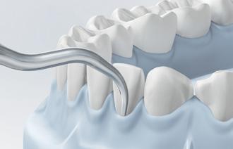 KA1 Końcówka periodontologiczna skalera do usuwania złogów w obszarze naddziąsłowym we wszystkich kwadrantach w obszarze ubytków stycznych i w kieszonce.