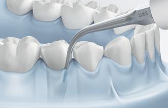 KA1 Końcówka periodontologiczna, długa, prosta - do usuwania złogów w obszarze poddziąsłowym do 9 mm głębokości w odcinku zębów