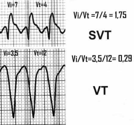 nadkomorowego SVT i równoczesnym wystąpieniu świeżego zawału serca przednio-przegrodowego. Taki częstoskurcz nadkomorowy może być fałszywie zinterpretowany jako częstoskurcz komorowy.