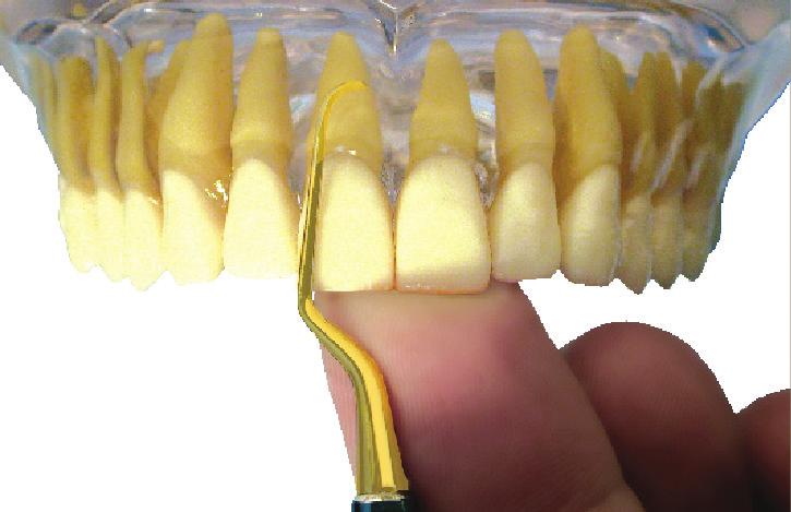 Ze zmniejszonym zużyciem instrumentu w technologii XP, Gracey Access Pro Thin zachowują swój oryginalny kształt oraz ustawienie ostrza pod kątem 70 stopni, zapewniając konsekwentną i skuteczną pracę