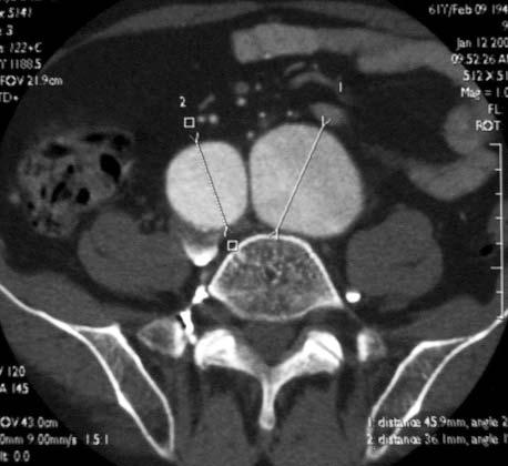 Niektóre stent-grafty s¹ wyposa one w specjalne haczyki przeciwdzia³aj¹ce obsuwaniu siê protezy migracji. Do chwili obecnej t¹ metod¹ zoperowano kilkadziesi¹t tysiêcy chorych na ca³ym œwiecie.