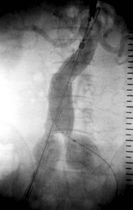 Ryc. 5. Aortografia. Angiogram œródoperacyjny. System (przed rozprê eniem) z g³ówn¹ czêœci¹ ( body ) i ipsilateraln¹ odnog¹ stent-graftu jest wprowadzony do aorty przez praw¹ têtnicê udow¹.