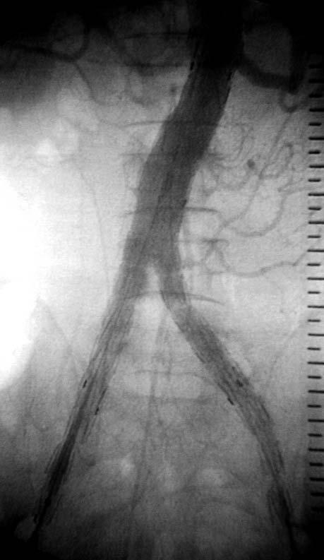 The main body and the ipsilateral stent-graft leg are introduced into the aorta through the right iliac artery.