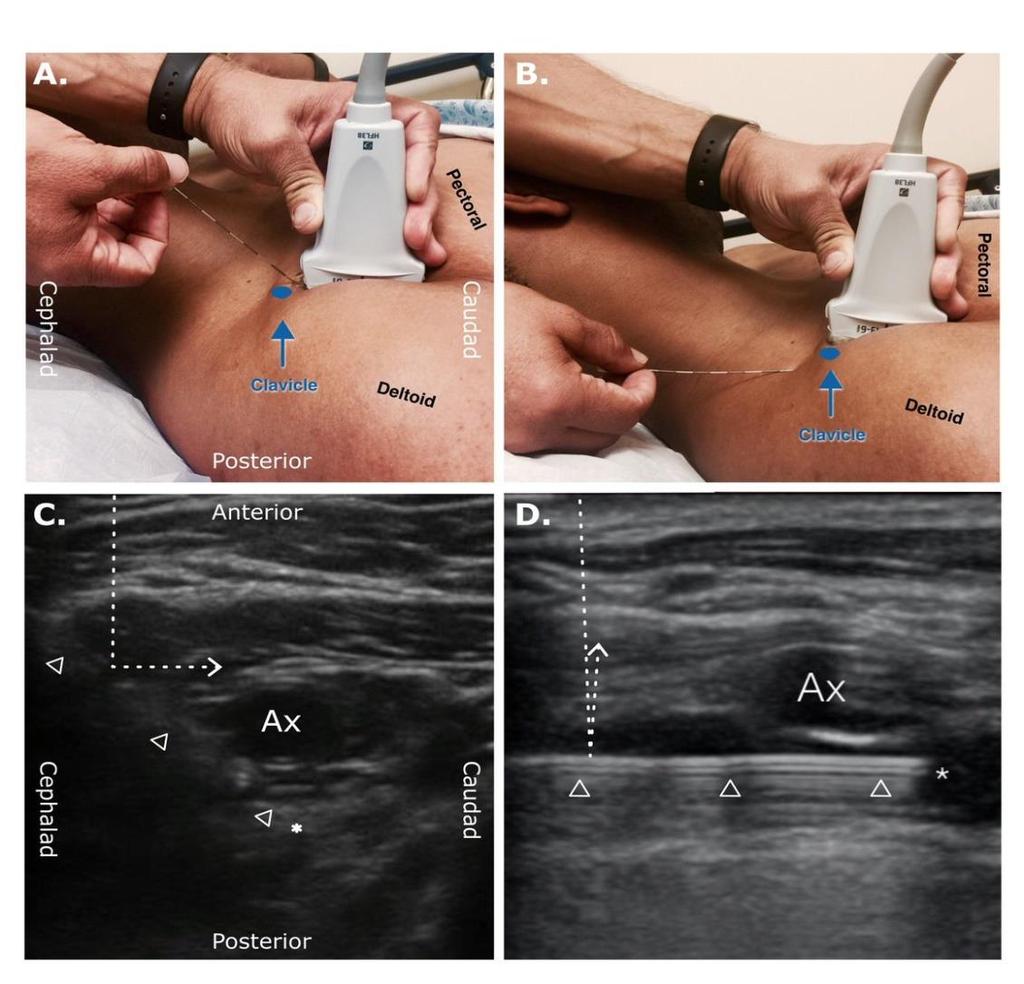 DOSTĘP ZAOBOJCZYKOWY DO PRZESTRZENI PODOBOJCZYKOWEJ (RAPTIR) Retroclavicular APproach To Infraclavicular Region ZALETY: Techniki ciągłe Unika naczynia (?