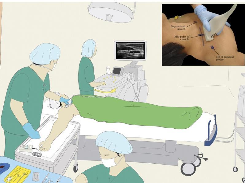 DOSTĘP ŻEBROWO-OBOJCZYKOWY DO SPLOTU RAMIENNEGO (COSTOCLAVICULAR APPROACH) CEL: