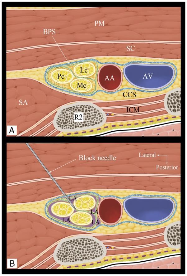 zmienna anatomia Głębokość blokady: tradycyjna 3-6cm; CCS o 1-2cm mniej.