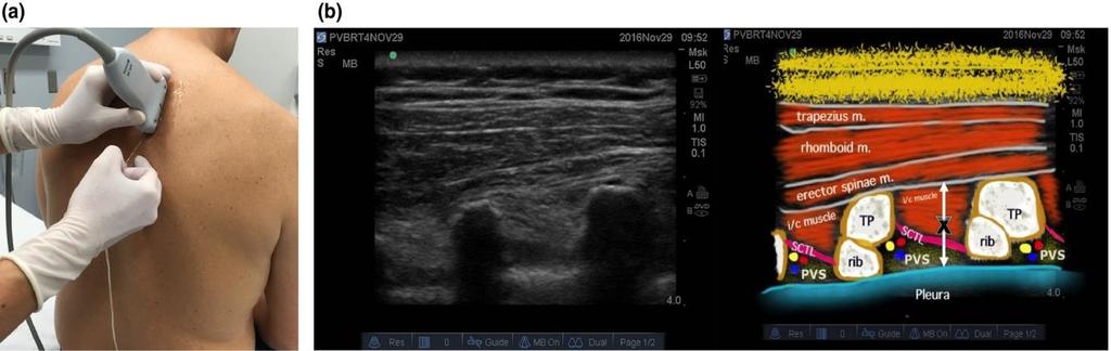 Transverse process to Pleura (MTP)