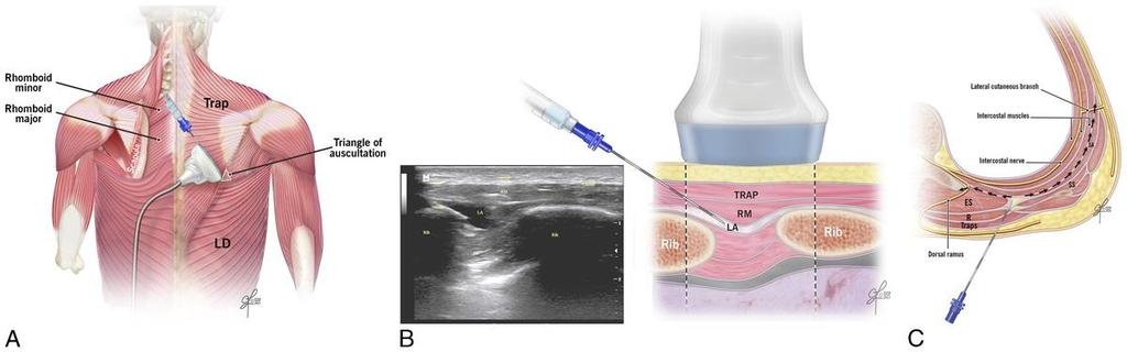 RHOMBOID INTERCOSTAL