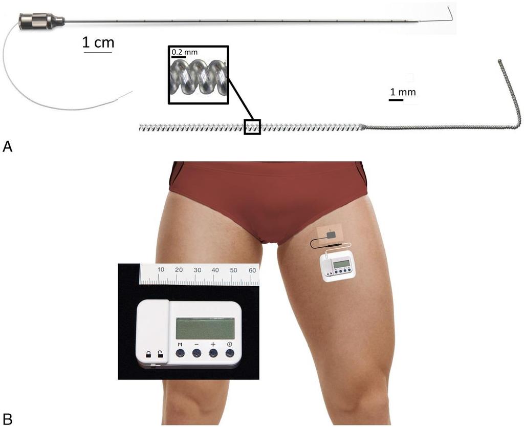 PRZEZSKÓRNA STYMULACJA NERWÓW OBWODOWYCH ppns (percutaneous