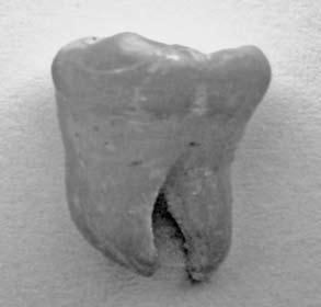Magnetic Resonance Imaging in Preclinical Dentistry 71 Fig. 3. Tooth A2 before experiment Ryc. 3. Ząb A2 przygotowany do badania Fig. 6.