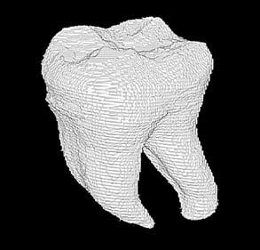 Trójwymiarowe rekonstrukcje komory oraz kanałów korzeniowych zęba A2 przed opracowaniem endodontycznym Fig. 4.