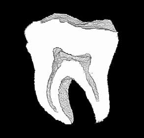 Tooth A2 after endodontic preparation Ryc. 7. Ząb A2 po opracowaniu endodontycznym Fig. 5.
