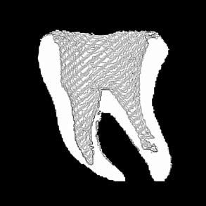 72 M. Tanasiewicz Fig. 9. Reconstructed representation external and inner space of A2 teeth after endodontic preparation Ryc. 9. Rekonstrukcja zewnętrzna oraz komory oraz kanałów korzeniowych zęba A2 po opracowaniu endodontycznym Fig.