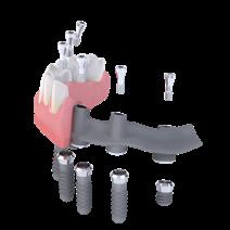 Planowanie odbudowy typu most overdenture na implantach - rozmieszczenie implantów 5.