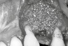 Master Course for the Management of Esthetic Implant Failures level Master Course in GBR and Sinus Floor Elevation Procedures level An interactive 3-day course with Live Surgeries course overview In