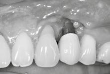 The most important causes for esthetic failures are malpositioned implants, the utilization of oversized implants, the wrong number of implants, surgical protocols which overstress the healing