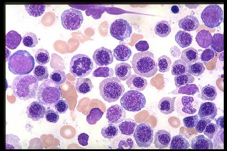 Nowotwory hematologiczne Grupa