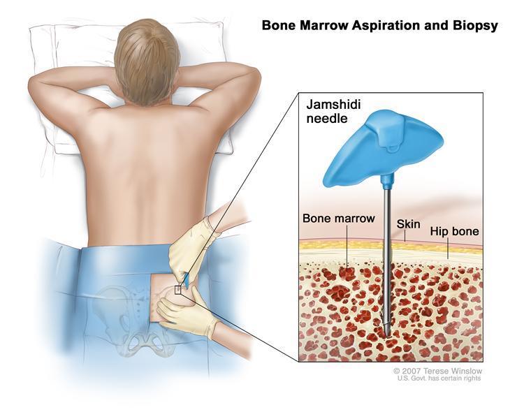 Biopsja aspiracyjna