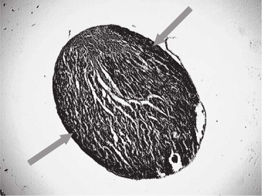 G E R I A T R I A 2012; 6: 207-211 Rycina 2. Mięsień brodawkowaty przegrodowy, 75 lat Tkanka mięśniowa szare strzałki Figure 2. Septal papillary muscle, 75 yrs Muscular tissue grey arrows Rycina 3.