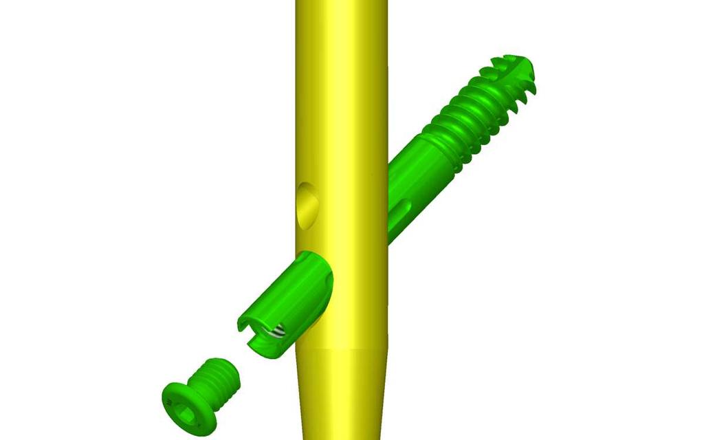 Nail interlocking with an interlocking bolt applied to the proximal part and antirotational Ø6,5mm.