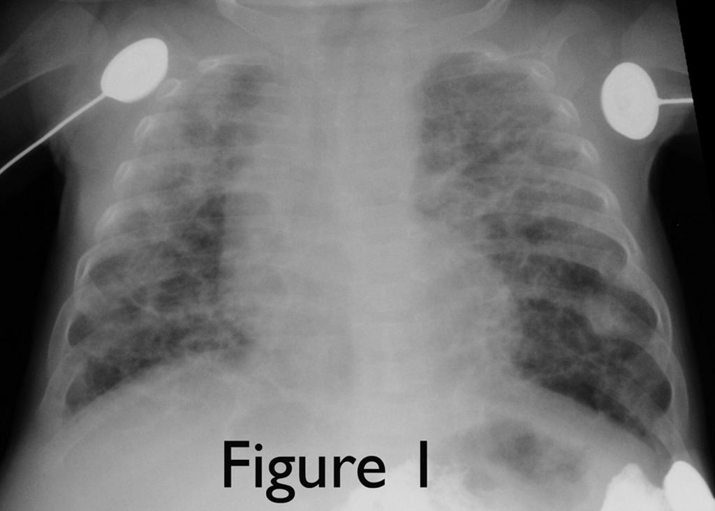 Klinicznie: zapotrzebowanie na tlenoterapię / wentylację w 36 tyg. wieku postkoncepc. Bronchopulmonary Dysplasia Laura R. Kair, Douglas T. Leonard, JoDee M. Anderson, Med.