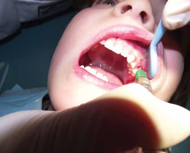 Dental Tribune Polish Edition Praktyka 3 dząc badania nad znieczuleniami stomatologicznymi, wprowadziła znieczulenie śródkostne przy pomocy urządzenia QuickSleeper.