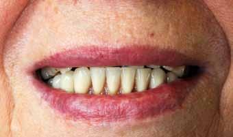 8 Praktyka Dental Tribune Polish Edition Przywrócenie estetyki i funkcji protezy z