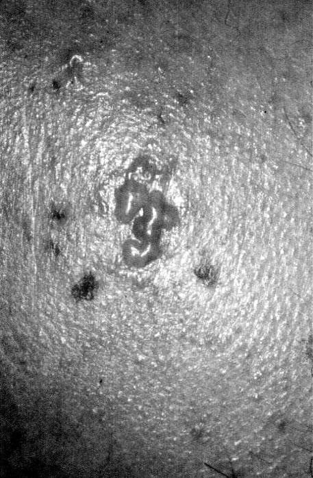 Różnorodność obrazu klinicznego linijnej IgA dermatozy pęcherzowej (LABD) Wstęp Linijna IgA dermatoza pęcherzowa (LABD linear IgA bulluos dermatosis) jest rzadko występującą jednostką chorobową,