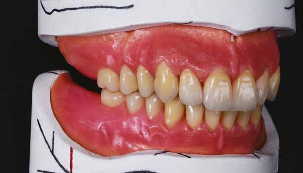 Technika Proteza overdenture Rhein'83 Proteza overdenture Wybory układu retencyjnego Autor tech. dent.