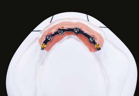 Proteza overdenture Technika Wnioski Uznając większą predyspozycję psychologiczną pacjentów do użytkowania