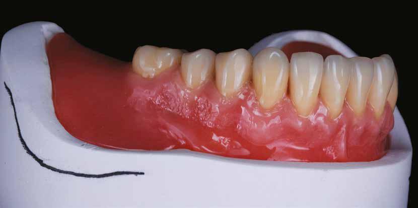 Technika Proteza overdenture fot. 33 