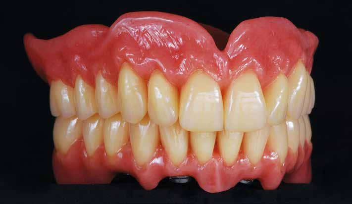 Proteza overdenture Technika fot. 35 fot. 36 