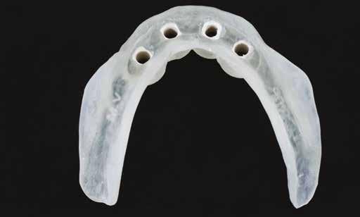Proteza overdenture Technika fot. 2 fot. 3 Przypadki kliniczne Pierwszy przypadek: pacjent użytkuje protezę overdenture na dwóch niskoprofilowych elementach retencyjnych (fot. 4).