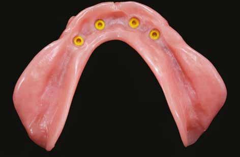 Proteza overdenture Technika fot. 6 fot. 7 fot. 6. Implanty umieszczone w przestrzeni kłów odchylenie powyżej 10 stopni fot. 7. Łączniki kulowe są preferowane w projektach protez o dobrych parametrach sytuacyjnych fot.