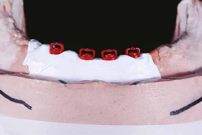 Technika Proteza overdenture fot. 10 