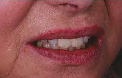 Proteza overdenture Technika fot. 20 